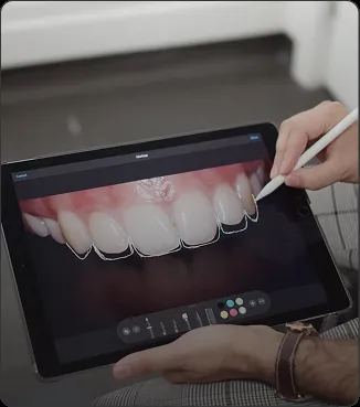 Composite Veneers
