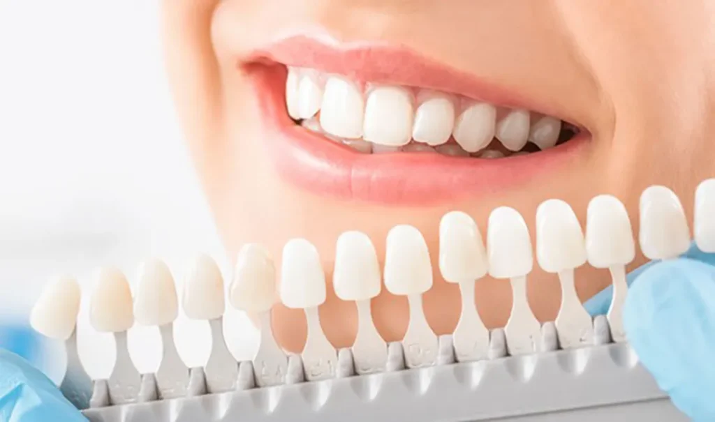 tooth shade guide against a patient's smile