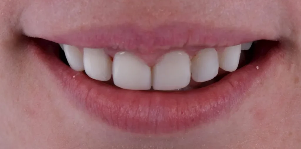 After photo showing straight
