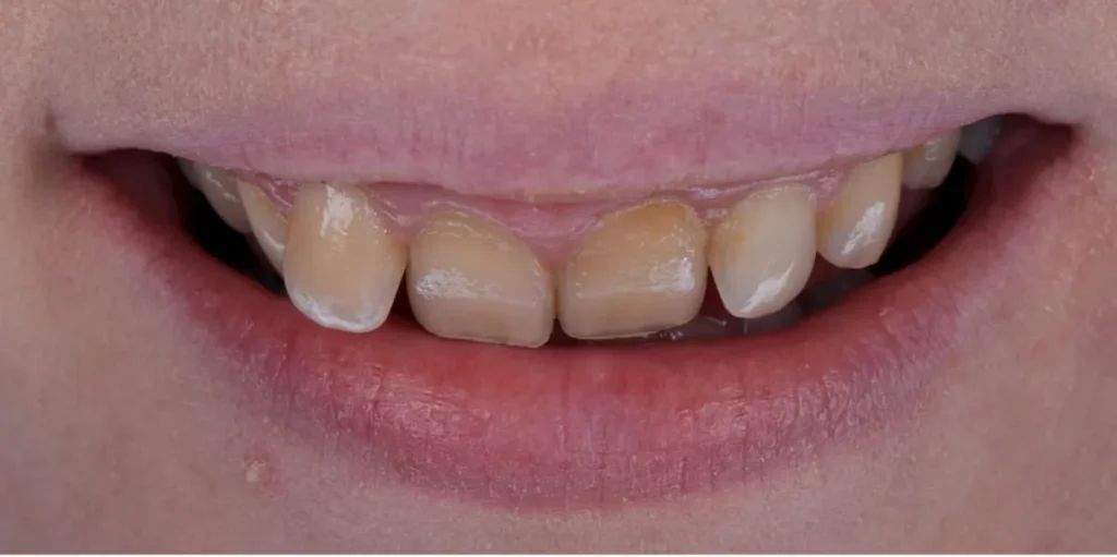 Before photo of patient's misaligned