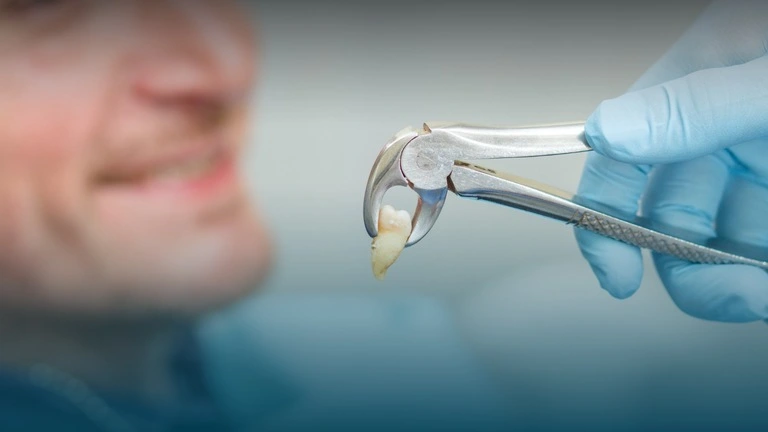 The Complete Guide to Tooth Extraction in the UK