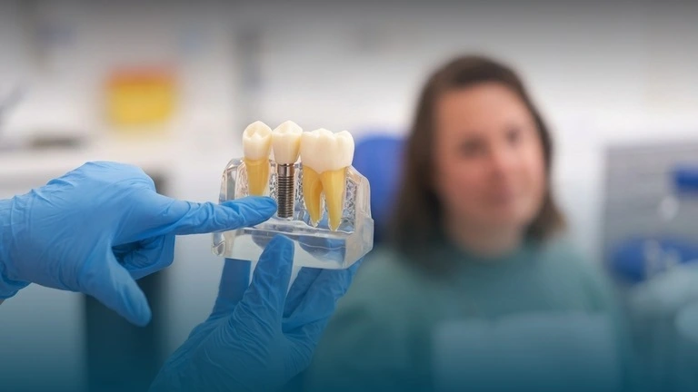 The Complete Guide to Dental Implants in London: Types, Costs & Procedure