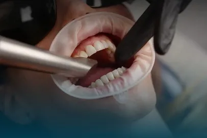 Everything to Know About Dental Veneers in London