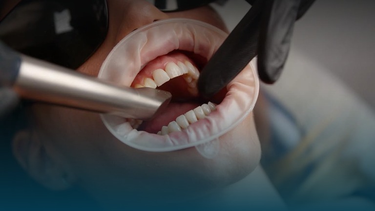 Everything to Know About Dental Veneers in London