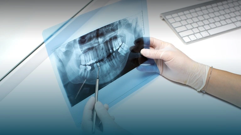 Complete Guide to Dental Bone Grafts in London