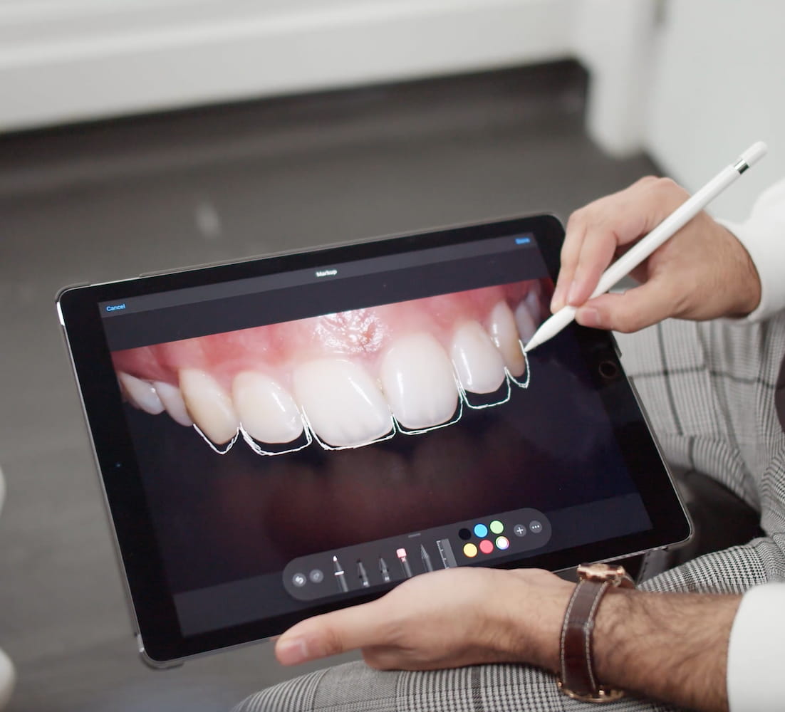 Veneers Twickenham Dental Crowns Richmond Free Consultation